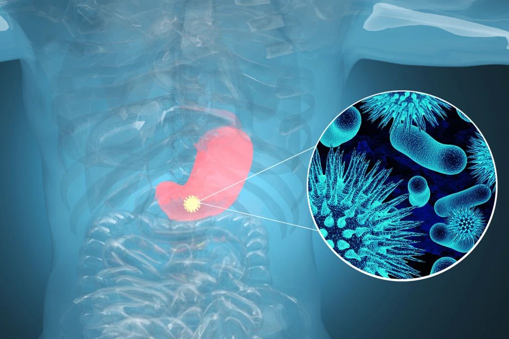 腫瘤標(biāo)記物CA72-4：“胃”，你還好嗎？